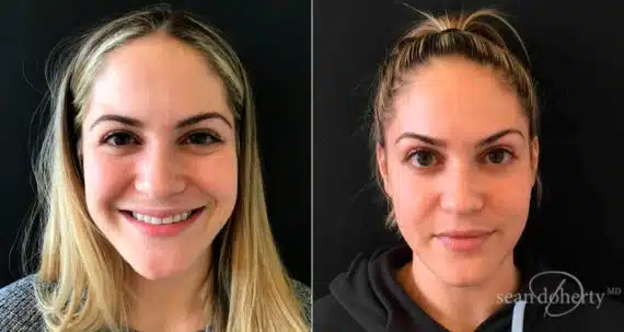 Botox Before and After Photos in Boston, MA, Patient 4030