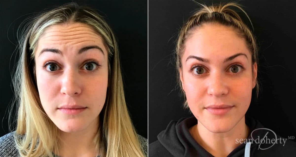 Botox Before and After Photos in Boston, MA, Patient 4030