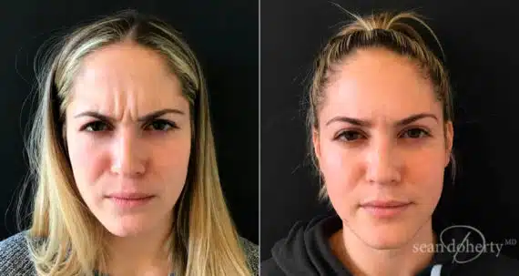 Botox Before and After Photos in Boston, MA