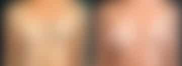 Breast Augmentation Before and After Photos in Boston, MA, Patient 4670