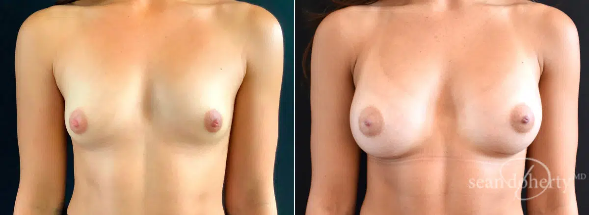 Breast Augmentation Before and After Photos in Boston, MA, Patient 4670