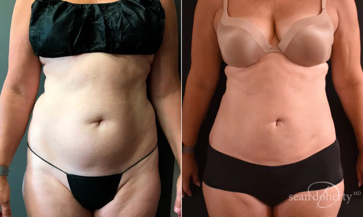 Liposuction Before and After Photos in Boston, MA, Patient 5760