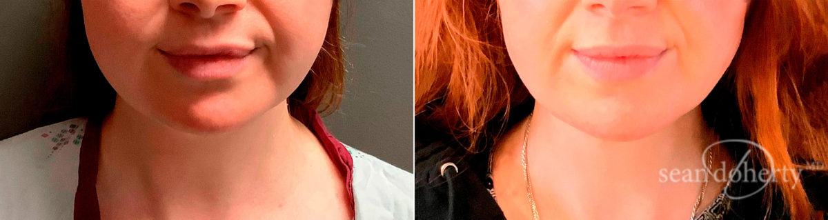 Patient 6702, Liposuction Before and After Photos Liposuction Before and After Photos in Boston, MA, Patient 6702