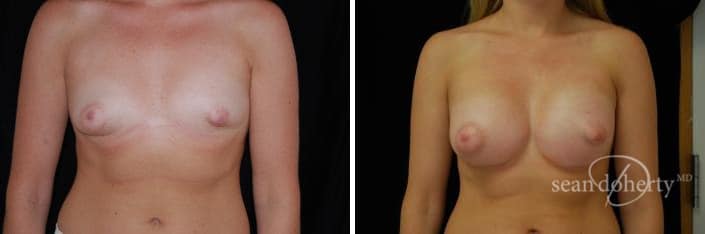 Breast Augmentation Before and After Photos in Boston, MA, Patient 2327