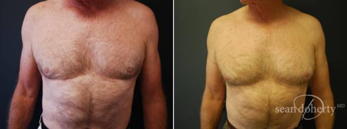 Liposuction Before and After Photos in Boston, MA, Patient 2562