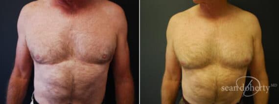 Liposuction Before and After Photos in Boston, MA, Patient 2562