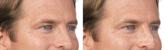 Botox Before and After Photos in Boston, MA, Patient 2582