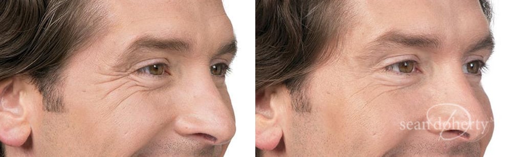 Botox Before and After Photos in Boston, MA, Patient 2597