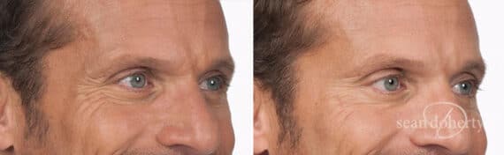 Botox Before and After Photos in Boston, MA, Patient 2612