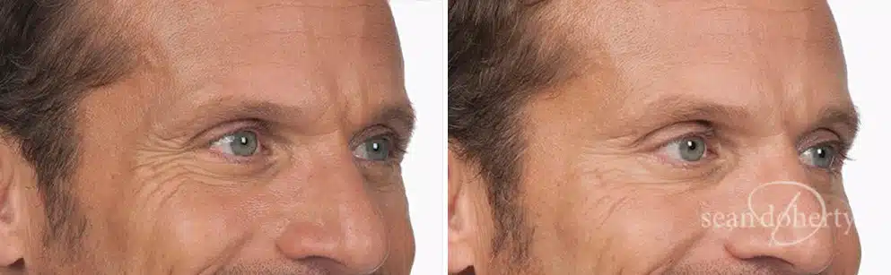 Patient 2612, Botox Before and After Photos Botox Before and After Photos in Boston, MA, Patient 2612