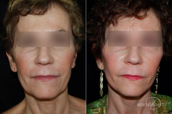 Facelift Before and After Photos in Boston, MA, Patient 3227