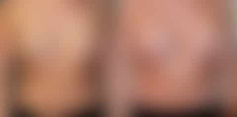 Breast Augmentation Before and After Photos in Boston, MA, Patient 3268