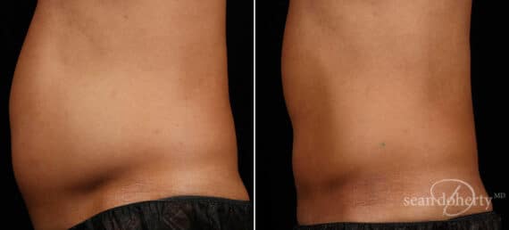 SculpSure Before and After Photos in Boston, MA, Patient 3367