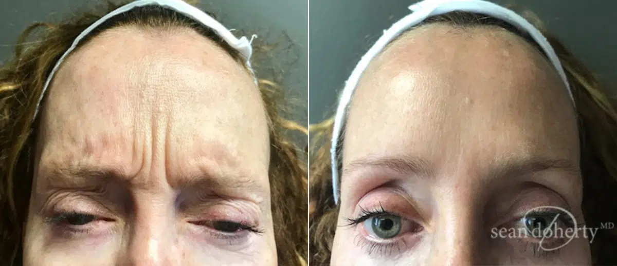 Botox Before and After Photos in Boston, MA, Patient 4074