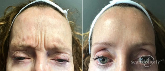 Botox Before and After Photos in Boston, MA, Patient 4074