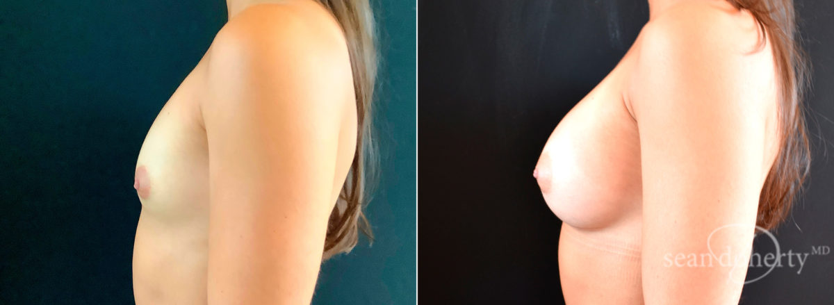 Breast Augmentation Before and After Photos in Boston, MA, Patient 4670