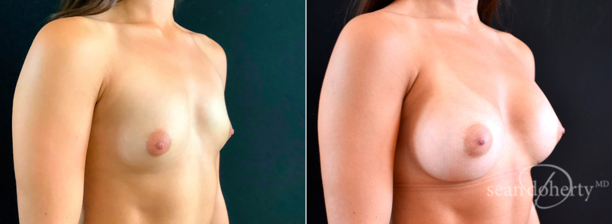 Breast Augmentation Before and After Photos in Boston, MA, Patient 4670