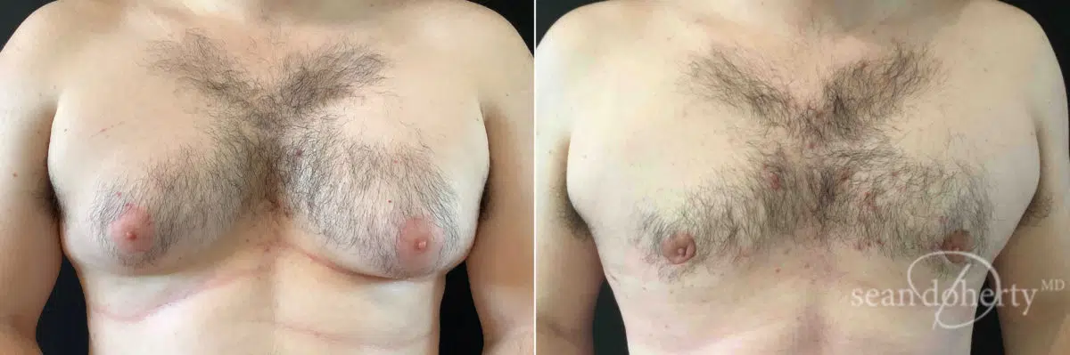 Gynecomastia Before and After Photos in Boston, MA, Patient 4737