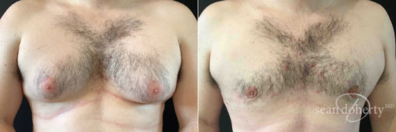 Gynecomastia Before and After Photos in Boston, MA