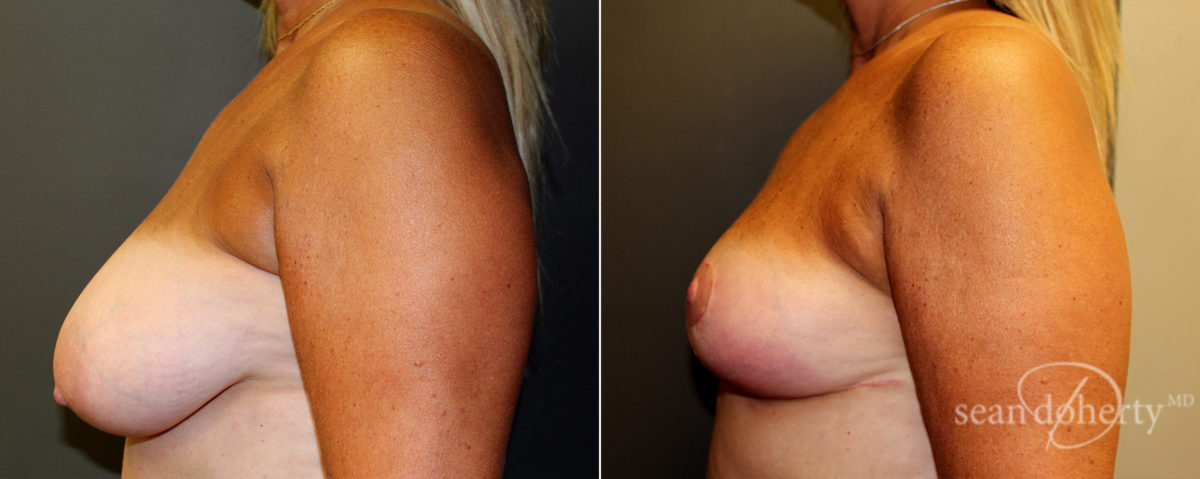 Breast Reduction Before and After Photos in Boston, MA, Patient 4773