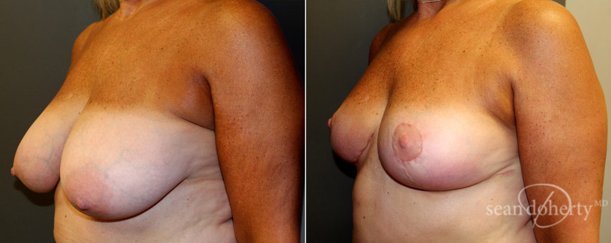 Breast Reduction Before and After Photos in Boston, MA, Patient 4773