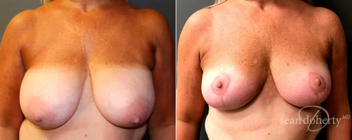 Breast Reduction Before and After Photos in Boston, MA, Patient 4773