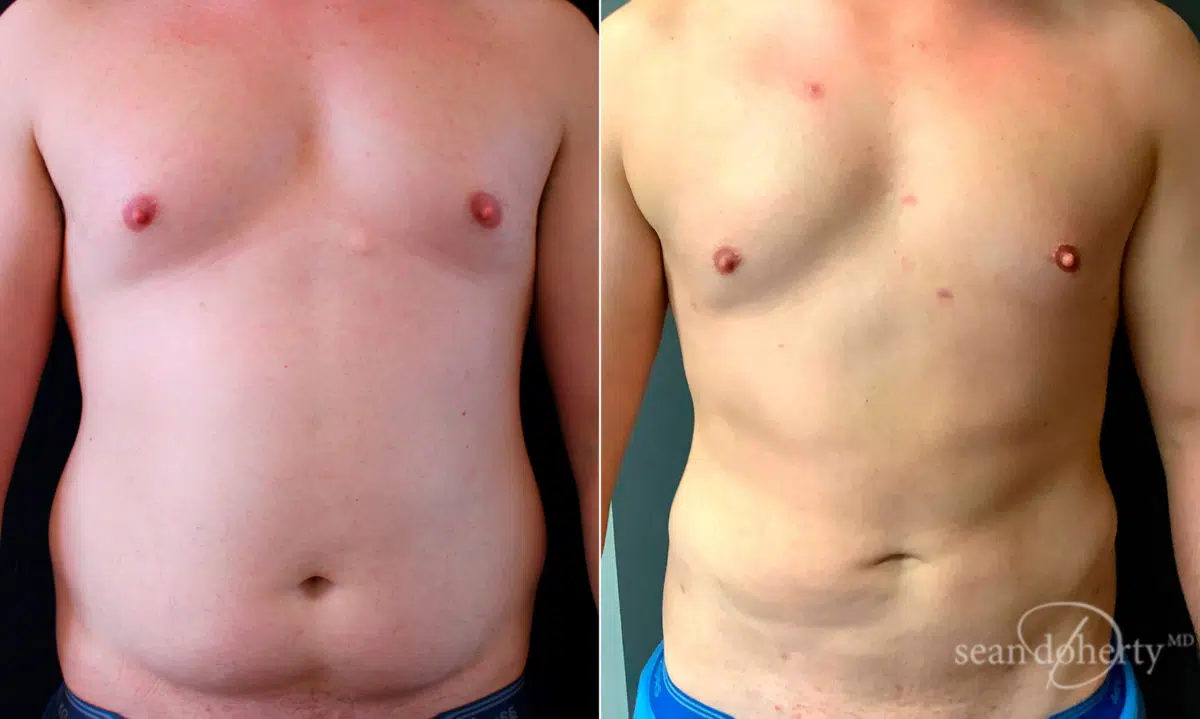 Liposuction Before and After Photos in Boston, MA, Patient 5039