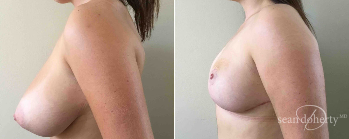 Breast Reduction Before and After Photos in Boston, MA, Patient 5149