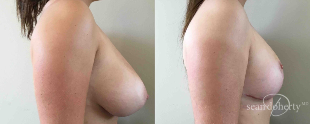 Breast Reduction Before and After Photos in Boston, MA, Patient 5149