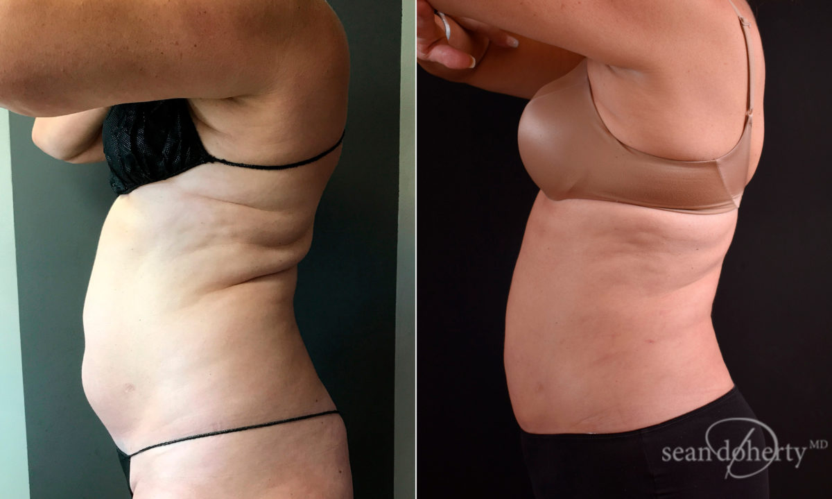 Liposuction Before and After Photos in Boston, MA, Patient 5760