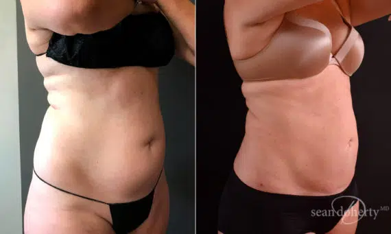 Liposuction Before and After Photos in Boston, MA, Patient 5760