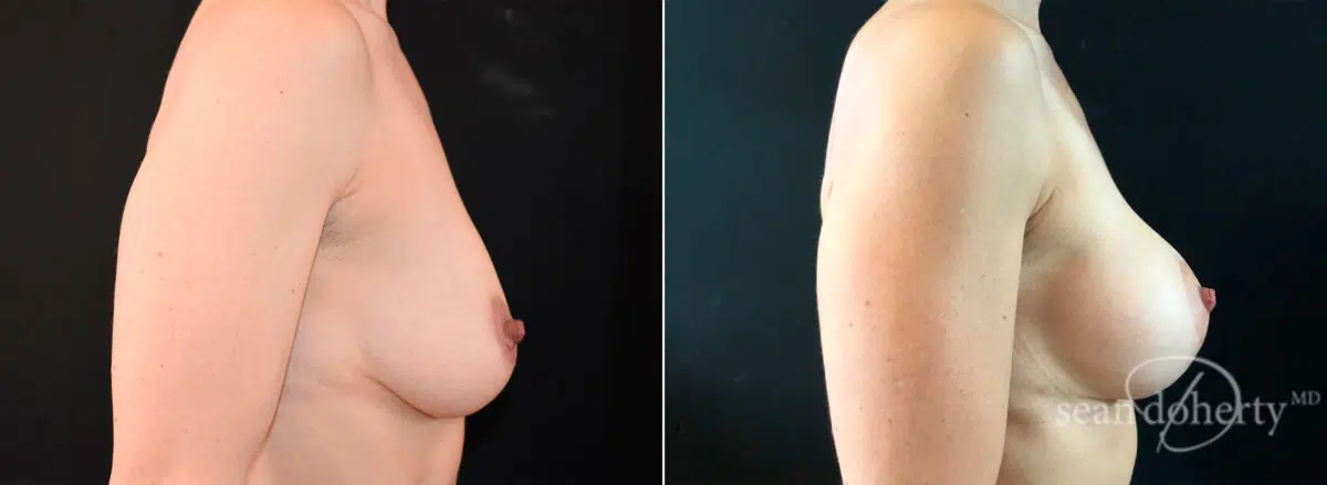 Breast Lift with Implants Before and After Photos in Boston, MA, Patient 5790