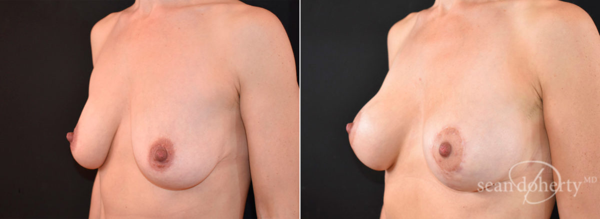 Breast Lift with Implants Before and After Photos in Boston, MA, Patient 5790