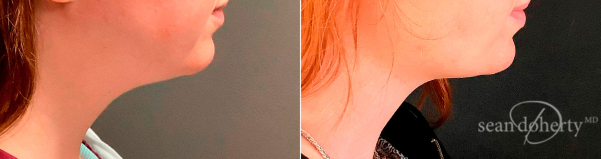 Patient 6702, Liposuction Before and After Photos Liposuction Before and After Photos in Boston, MA, Patient 6702