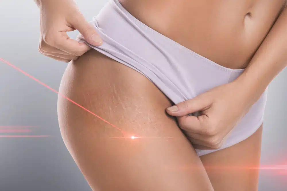 When it comes to actual lasers, there are two types: ablative and non-ablative.