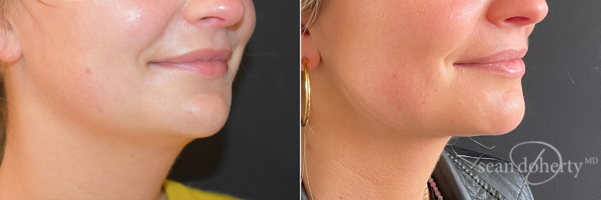 Local Anesthesia Liposuction Boston