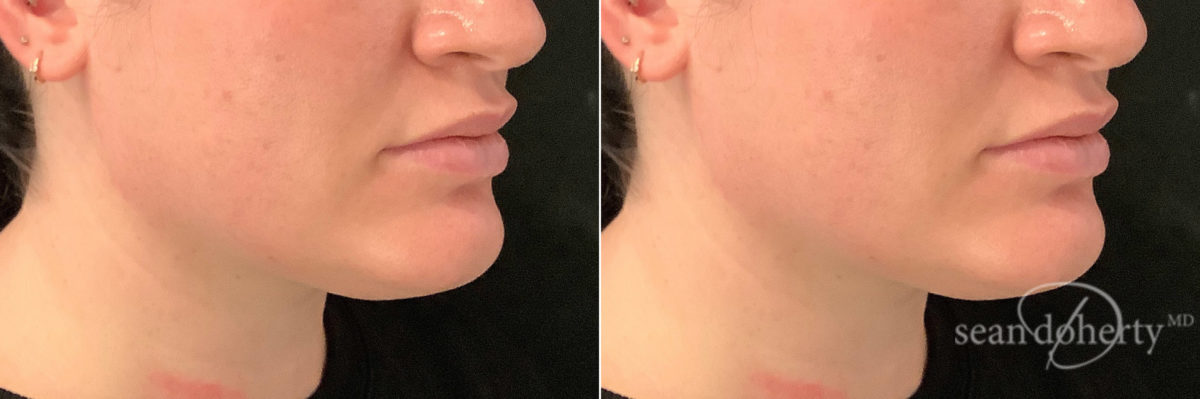 Liposuction Before and After Photos in Boston, MA, Patient 7585