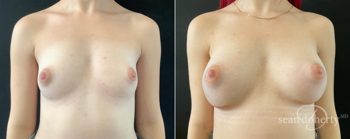 Patient 7626, Breast Augmentation Before and After Photos Breast Augmentation Before and After Photos in Boston, MA, Patient 7626
