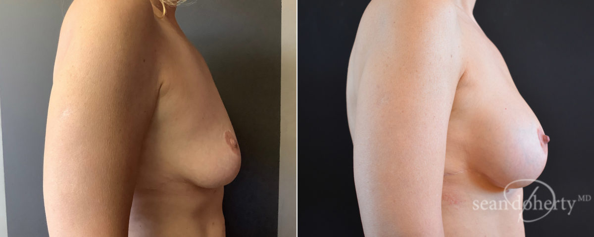 Patient 7636, Breast Augmentation Before and After Photos Breast Augmentation Before and After Photos in Boston, MA, Patient 7636