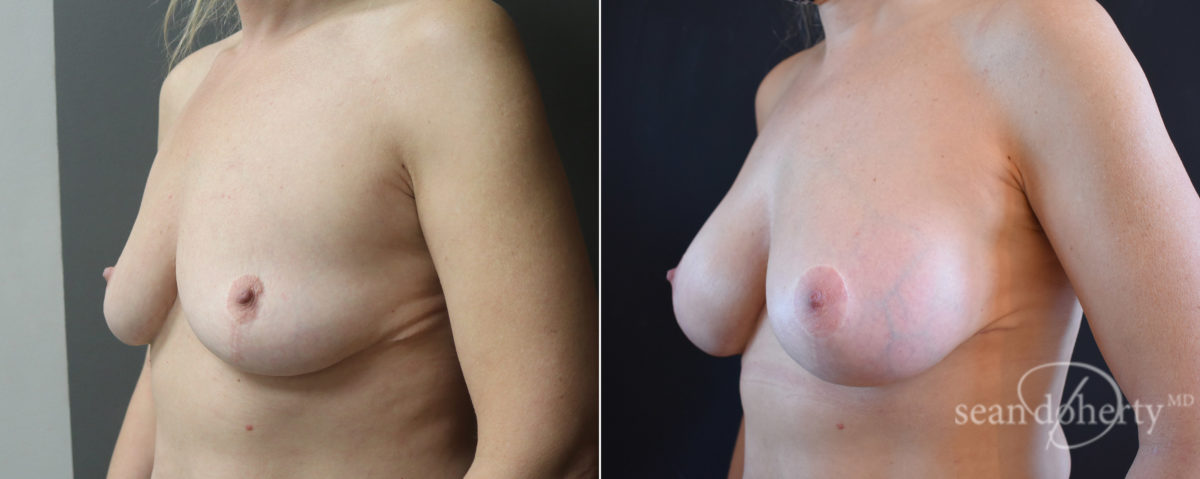 Patient 7636, Breast Augmentation Before and After Photos Breast Augmentation Before and After Photos in Boston, MA, Patient 7636