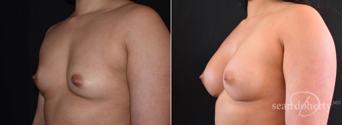 Patient 7684, Breast Augmentation Before and After Photos Breast Augmentation Before and After Photos in Boston, MA, Patient 7684