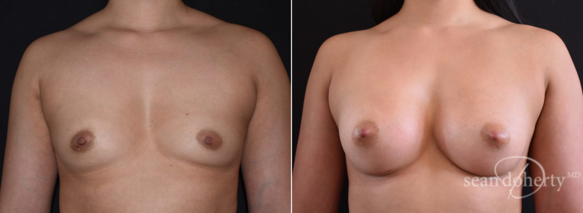 Patient 7684, Breast Augmentation Before and After Photos Breast Augmentation Before and After Photos in Boston, MA, Patient 7684