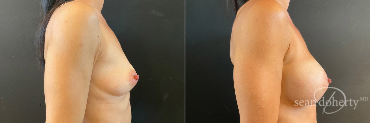 Patient 7717, Breast Augmentation Before and After Photos Breast Augmentation Before and After Photos in Boston, MA, Patient 7717