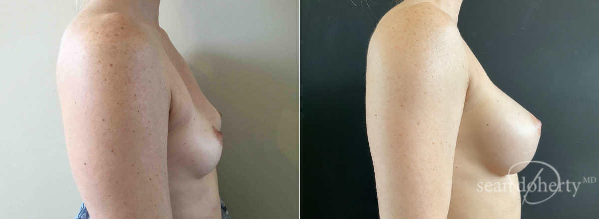 Patient 7755, Breast Augmentation Before and After Photos Breast Augmentation Before and After Photos in Boston, MA, Patient 7755