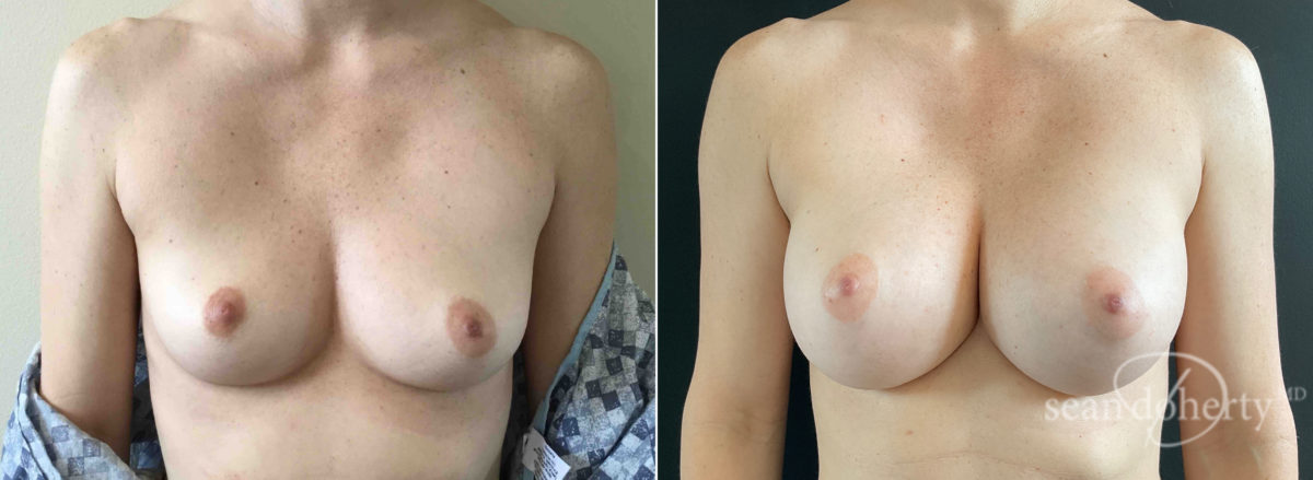 Patient 7755, Breast Augmentation Before and After Photos Breast Augmentation Before and After Photos in Boston, MA, Patient 7755