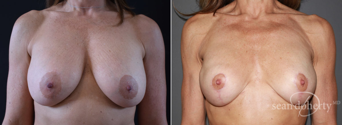 Patient 7757, Breast Lift Before and After Photos Breast Lift Before and After Photos in Boston, MA, Patient 7757