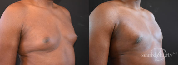 Gynecomastia Before and After Photos in Boston, MA, Patient 7758