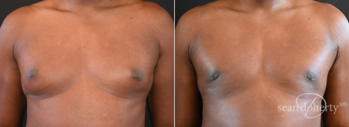 Gynecomastia Before and After Photos in Boston, MA, Patient 7758