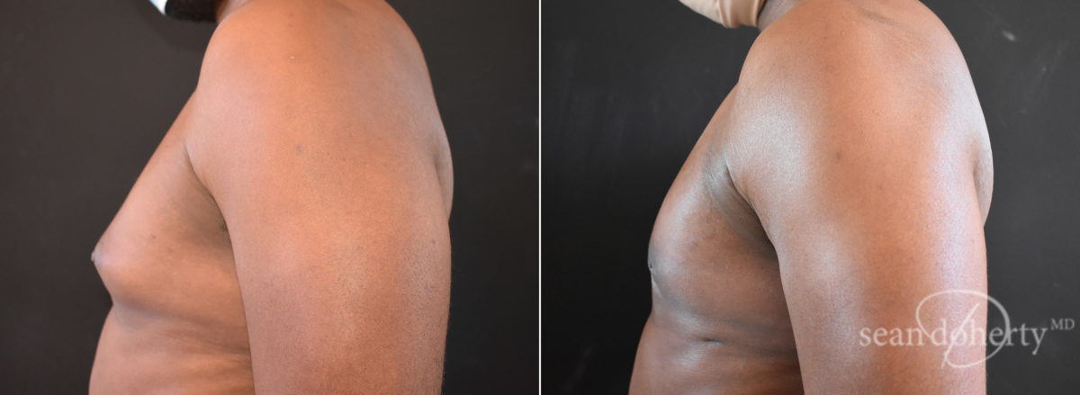 Gynecomastia Before and After Photos in Boston, MA, Patient 7758