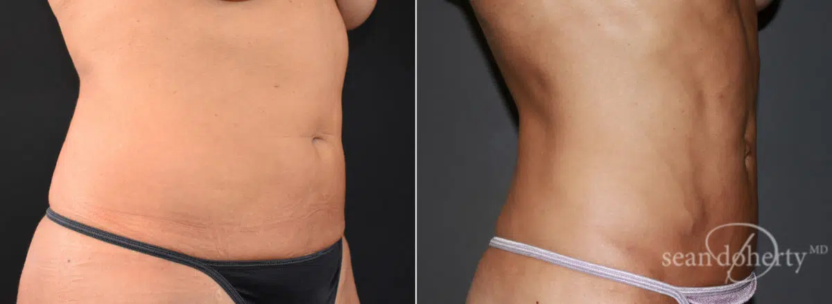 Liposuction Before and After Photos in Boston, MA, Patient 7797